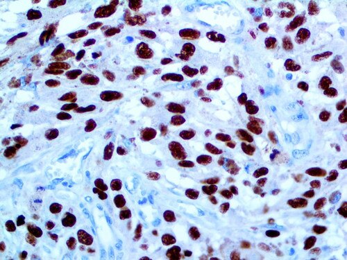 SOX-10 MMab Antibody Immunohistochemistry on a FFPE Melanoma Tissue